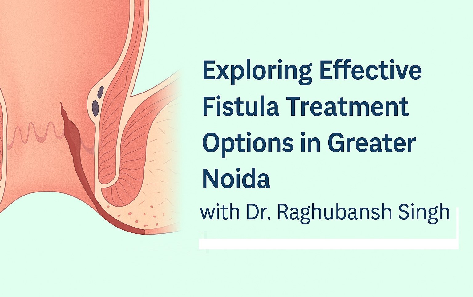Fistula Treatment in Greater Noida