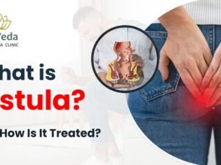 fistula doctor in Delhi NCR