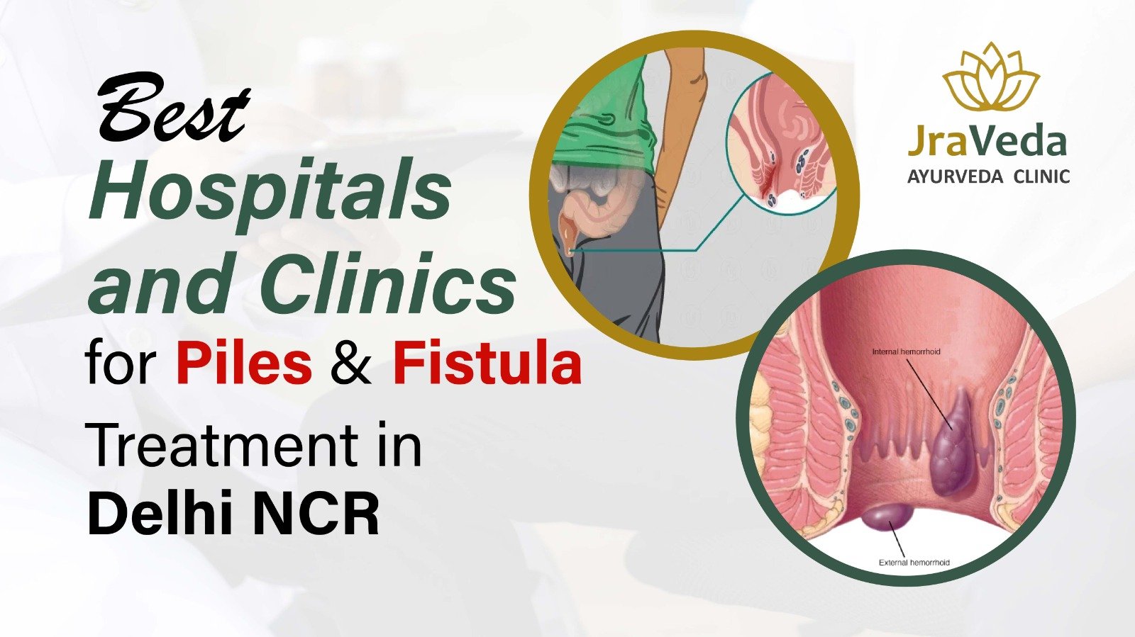 Best Fistula Treatment in Delhi NCR